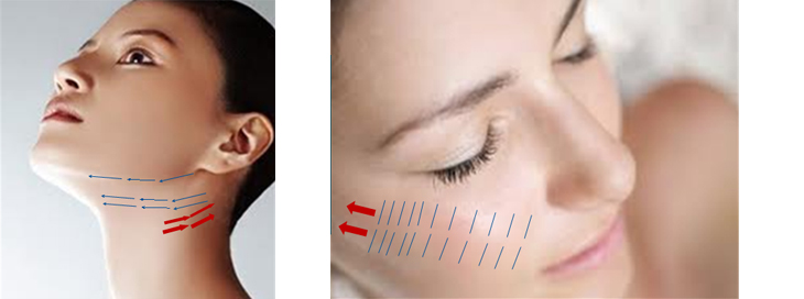 Microthreadlift diagrams- KFDA approved treatment - Hong Kong