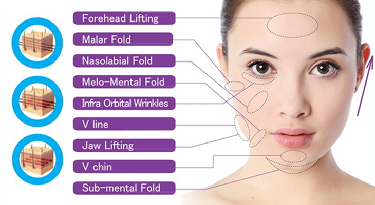 Ultra-V-Lift facial diagram - Hong Kong